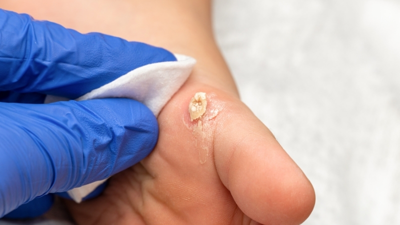 Wart Treatment